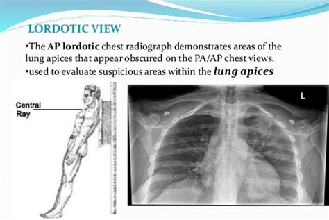 apicolordotic meaning|Apical zone .